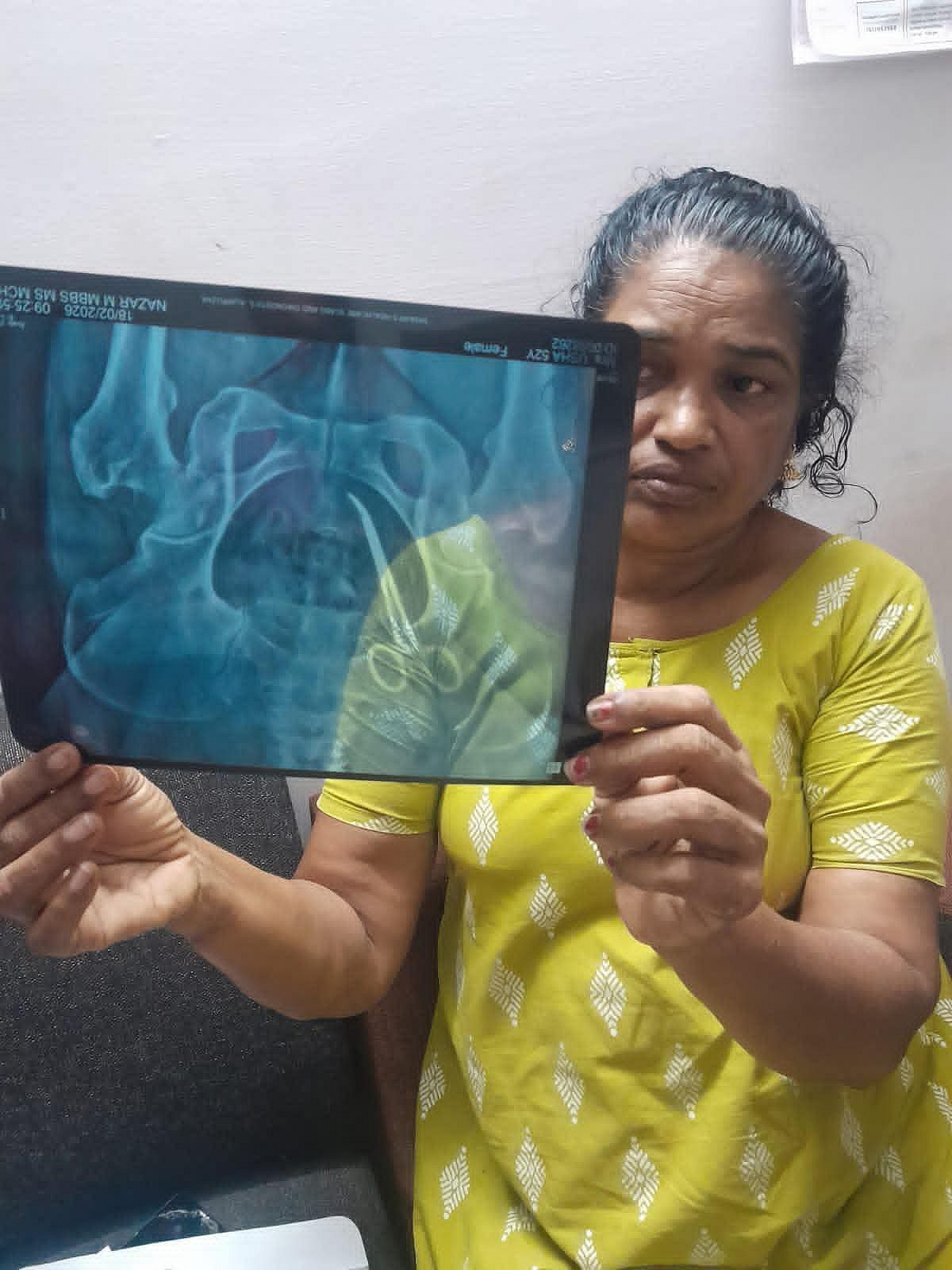 மூதாட்டி உஷா ஜோசப் வயிற்றில் கத்தரிக்கோல் இருக்கும் எக்ஸ்ரே காட்சி